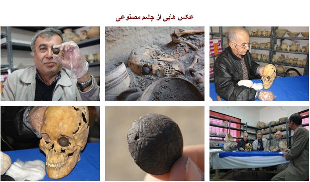 در شهر سوخته چشم مصنوعی پیدا شده است