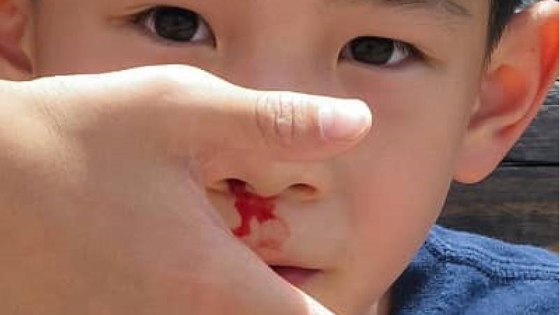 خونریزی بینی در کودکان چه زمانی خطرناک است