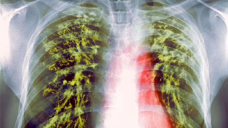 علایم بیماری سال و راه‌های انتقال آن چیست