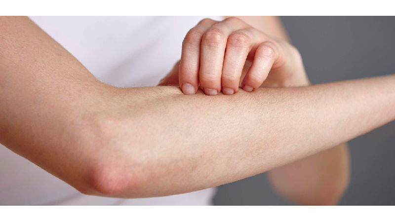 بیماری زونا چیست و چه علائم و عوارضی دارد