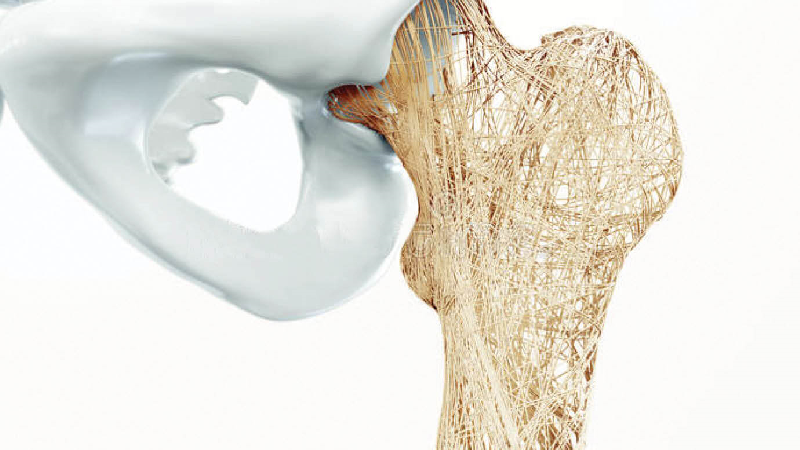 علل پوکی استخوان چیست