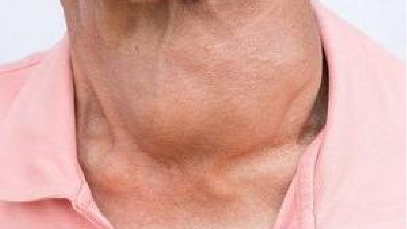 علائم پرکاری و کم کاری تیروئید در زنان و مردان