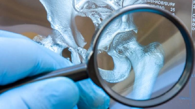 سنجش سلامت استخوان چگونه انجام می‌شود