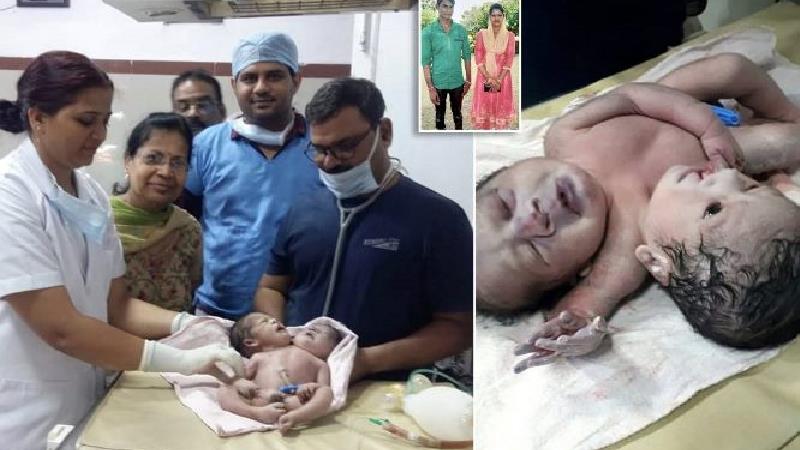 تولد نوزادی با 2 سر و 3 دست