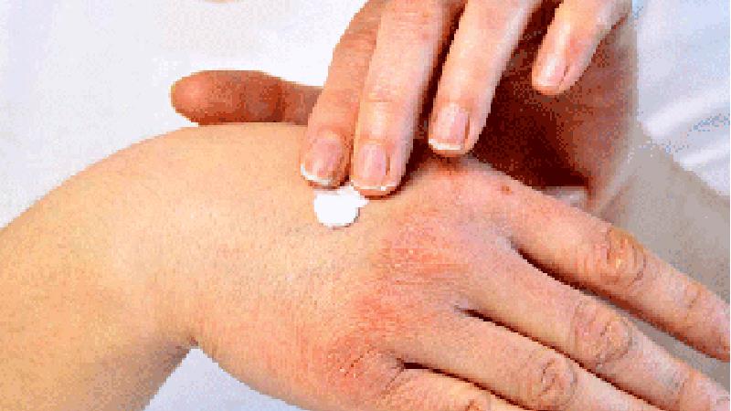 بهترین روش‌ها برای ‌د‌‌رمان اگزما چیست