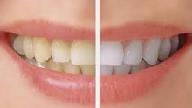 بروساژ یا پولیش دندان چیست و چه فرقی با جرم‌ گیری دارد