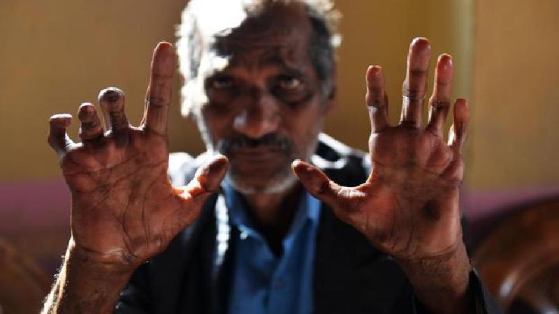 جذام چیست و چه کسانی به آن مبتلا می‌شوند