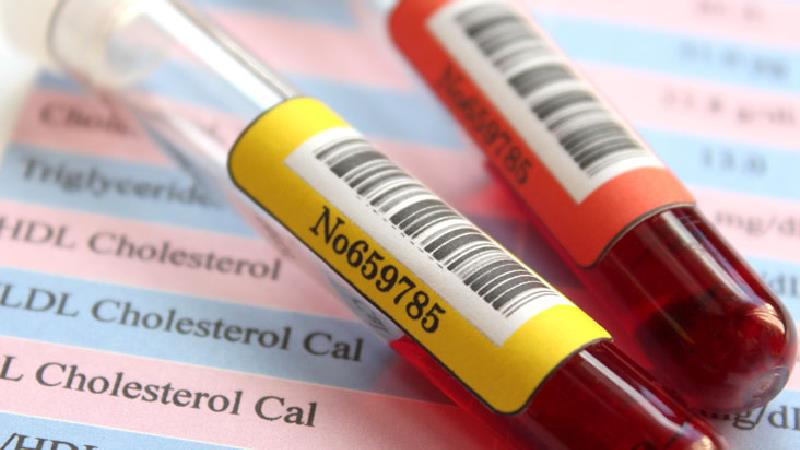 در این مواقع کلسترول خود را حتما بررسی کنید