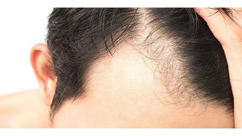 آلوپسی همان ریزش مو است