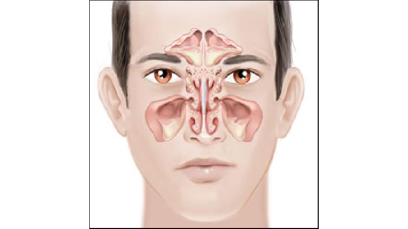 با علایم سینوزیت آشنا شوید