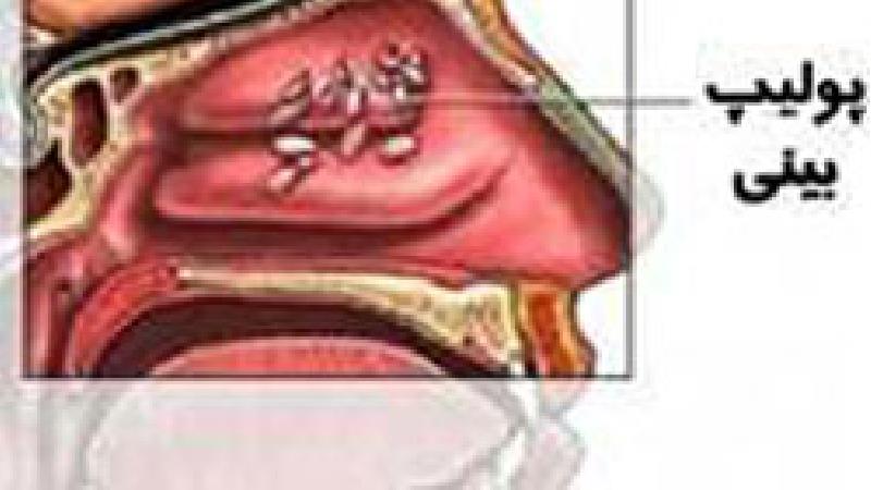 پولیپ بینی چیست