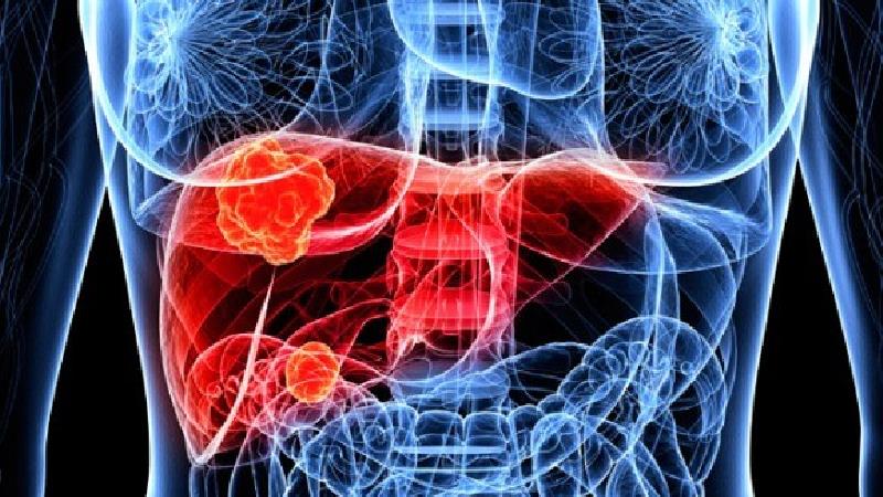 عواملی که باعث افزایش احتمال ابتلا به سرطان کبد می‌شود