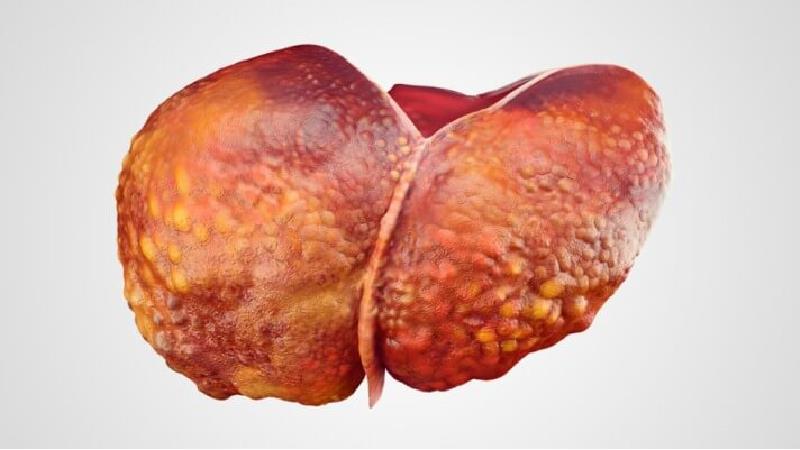 عواملی که باعث افزایش احتمال ابتلا به سرطان کبد می‌شود