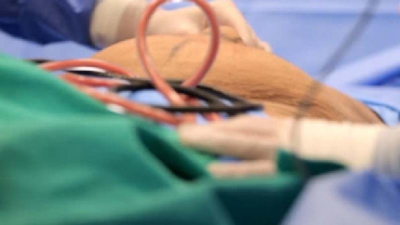 آیا برای لاغری لیپوساكشن انجام بدهیم؟