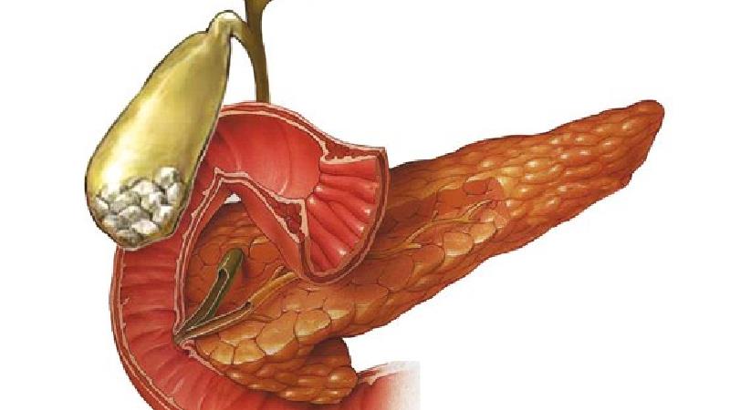 سنگ کیسه صفرا چرا ایجاد می‌شود