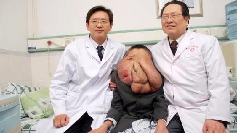 مردی 38 ساله در چین که به بیماری ژنتیکی نوروفیبروماتوز مبتلا است لقب زشت‌ترین فرد جهان را گرفت.