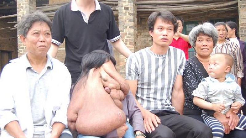 مردی 38 ساله در چین که به بیماری ژنتیکی نوروفیبروماتوز مبتلا است لقب زشت‌ترین فرد جهان را گرفت.