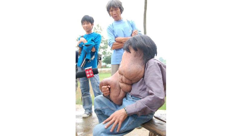 مردی 38 ساله در چین که به بیماری ژنتیکی نوروفیبروماتوز مبتلا است لقب زشت‌ترین فرد جهان را گرفت.