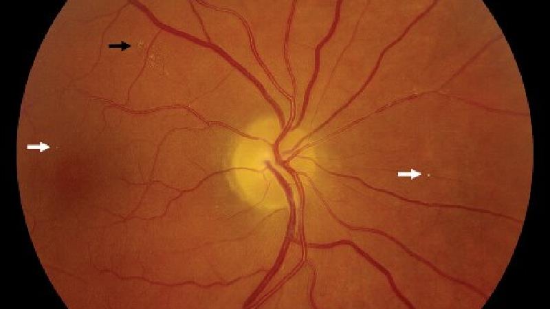 علت های سکته چشمی گوناگون است