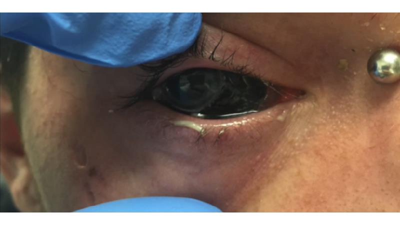 سکته چشمی سه نوع مختلف دارد