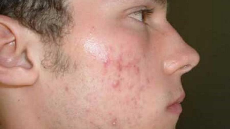 آکنه به چه دلیل به وجود می آید