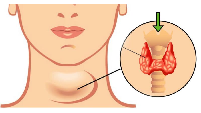 چه دلایلی باعث کم کاری تیروئید می شود