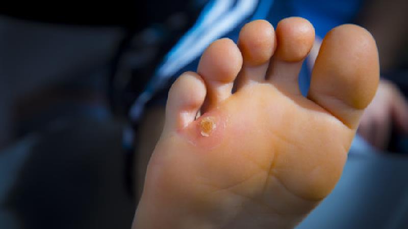 از روغن کرچک برای از بین بردن میخچه استفاده می شود