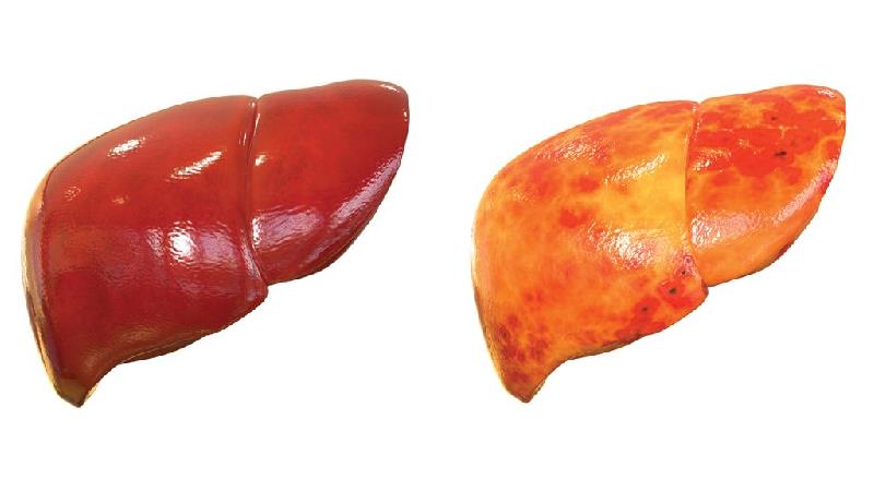 خاصیت داروهای گیاهی برای کبد چرب