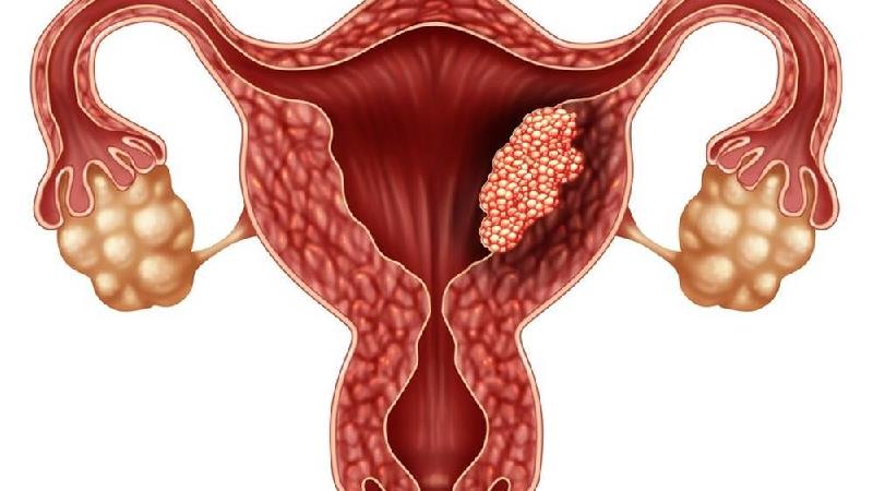 سرطان آندومتر سرطان  دیواره‌ داخلی اندومتریوم است. 