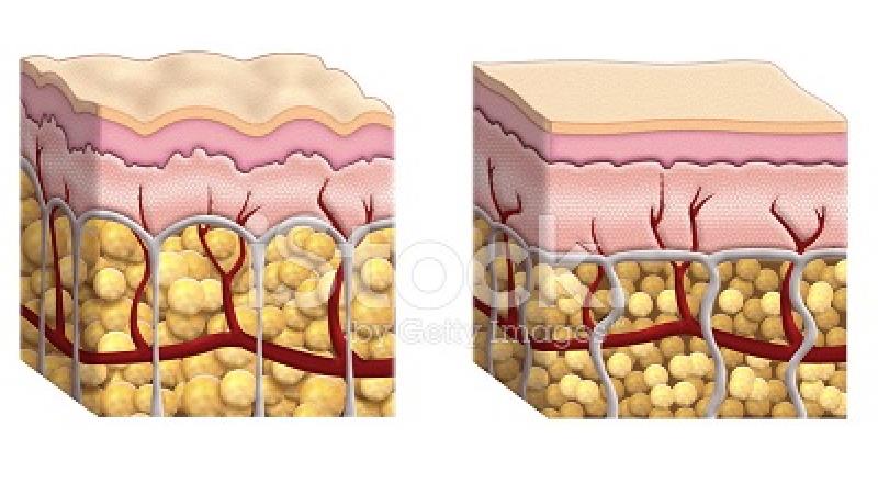 سلولیت چگونه درمان می شود
