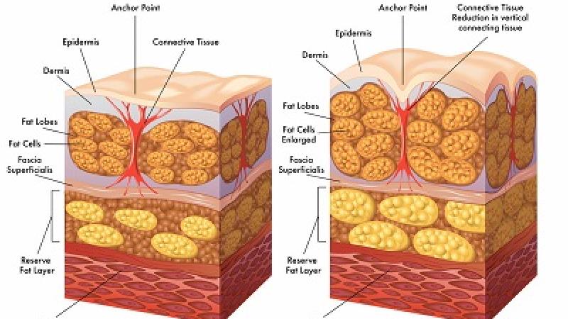 بیماری سلولیت چیست