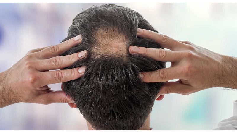 دلایل ریزش مو چیست