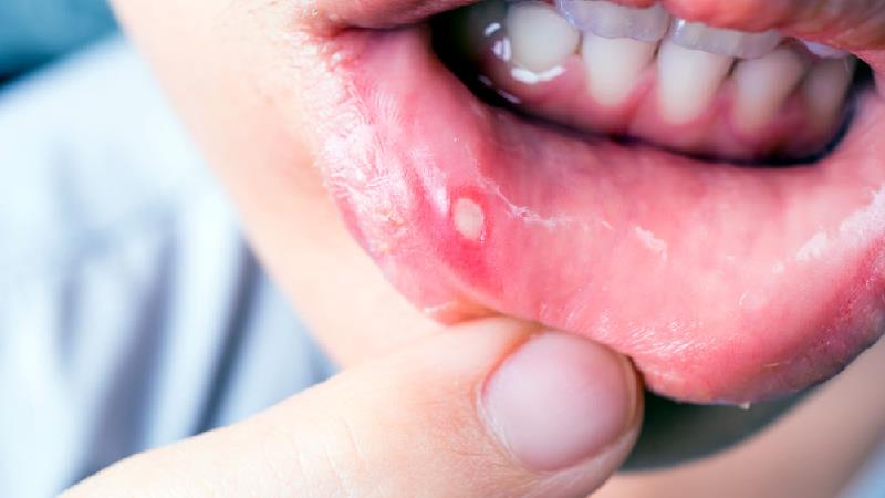 دلایل آفت دهان چیست