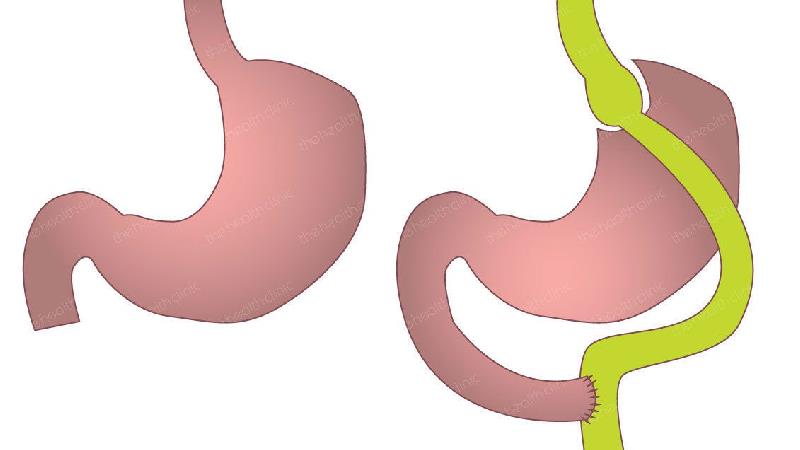 عمل بای پس روده چه عوارضی دارد