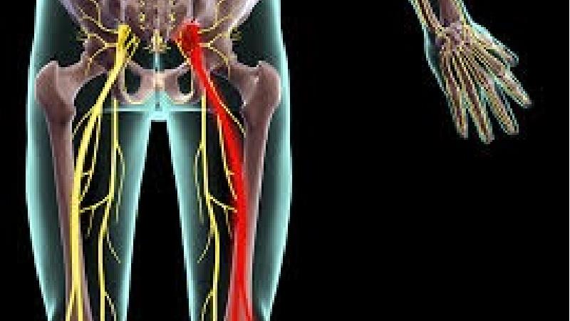 سیاتیک یکی از بلندترین عصب های بدن است