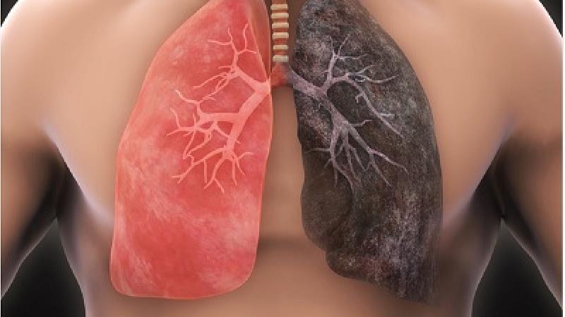سرطان ریه چه دلایلی دارد