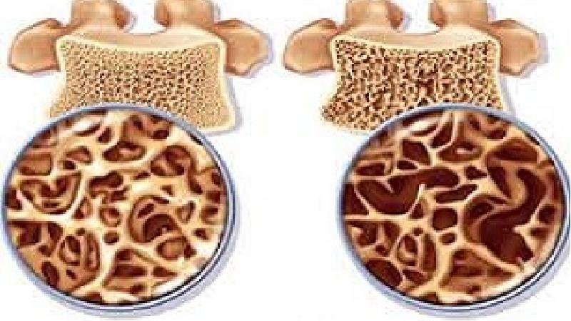 استخوان های خود را چگونه تقویت کنیم