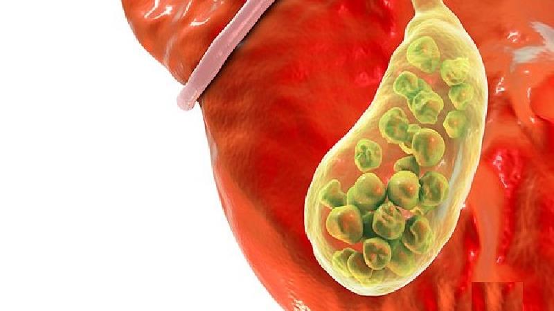 سنگ صفرا چرا تشکیل می شود