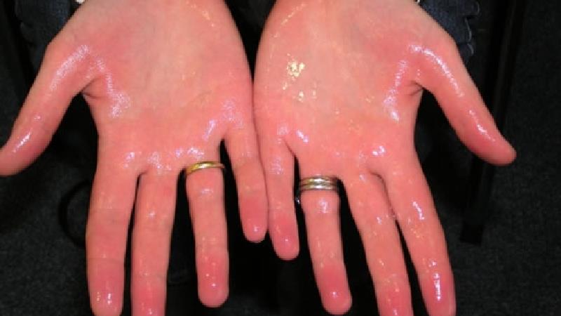 کف دست ها به چه دلیل عرق می کند