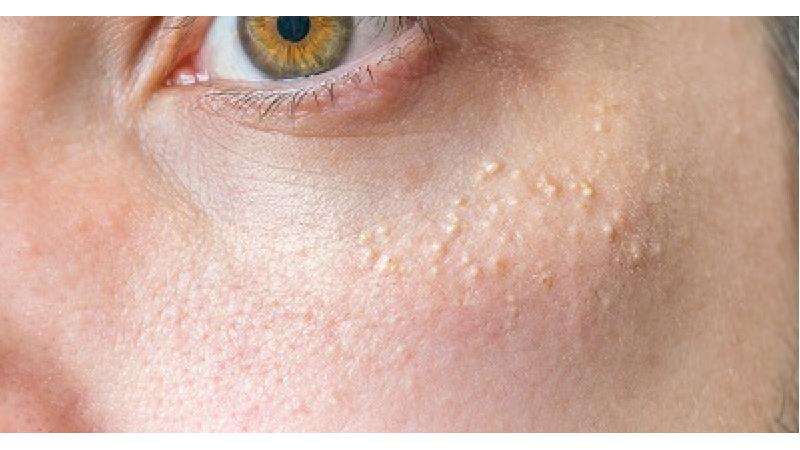 بیماری میلیا چه نشانه هایی دارد