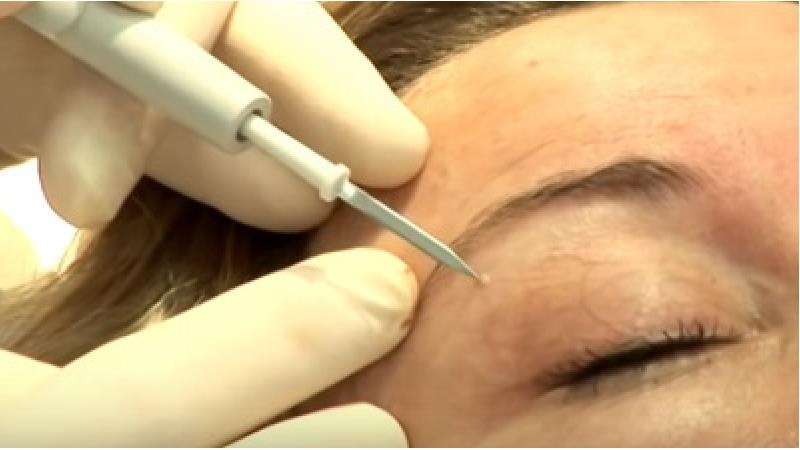 میلیا چگونه درمان می شود