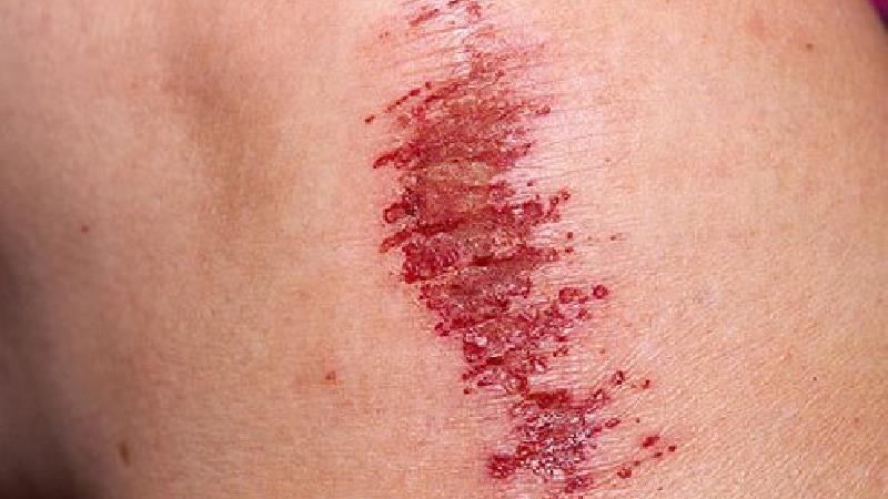 زخم ها و سختگی ها ممکن است باعث سپسیس شوند