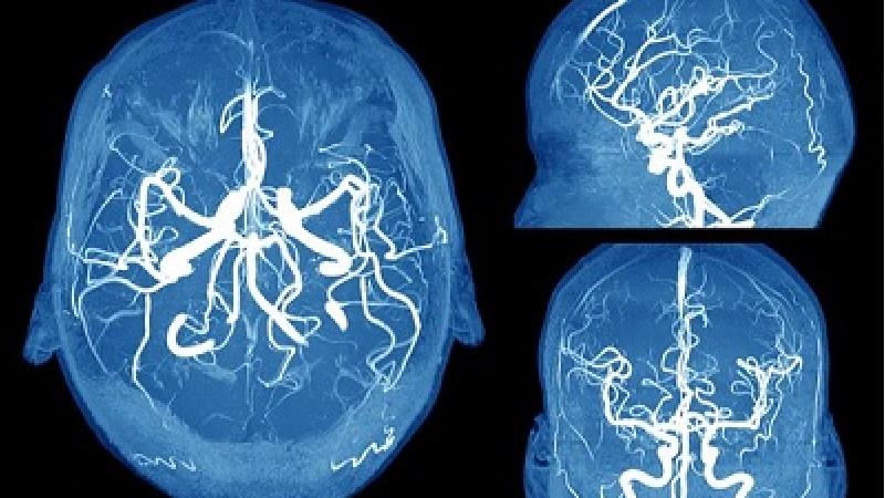 انوریسم مغزی به چه نوع بیماری گفته می شود