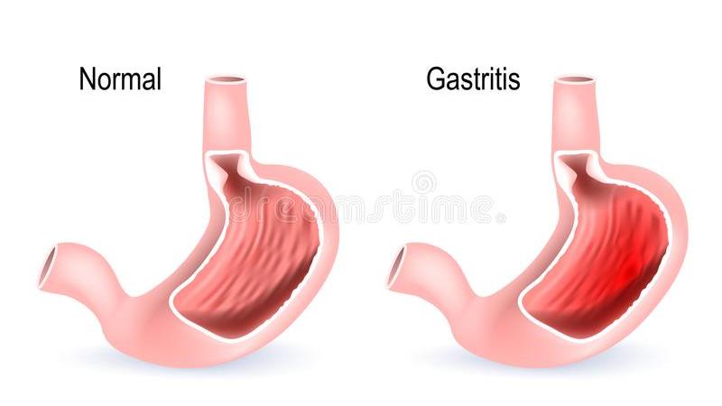 گاستریت معده دقیقا چیست