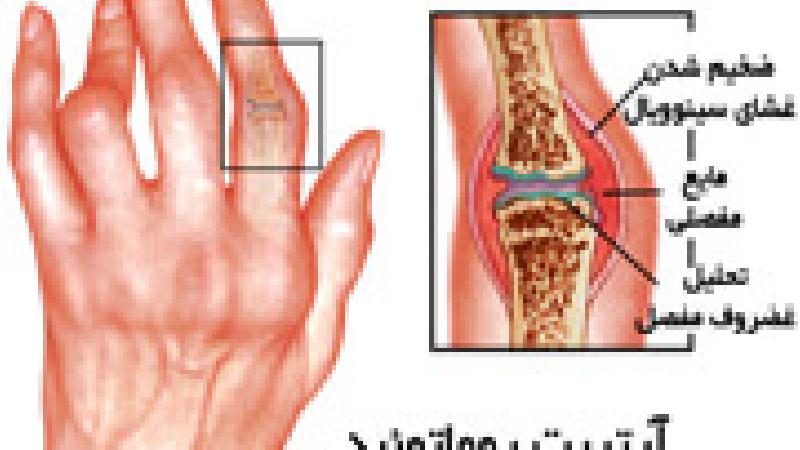 آرتریت روماتوئید چه عوارضی دارد