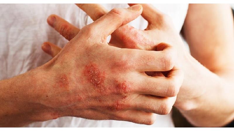 اگزما یکی از علایم مشکلات گوارشی است