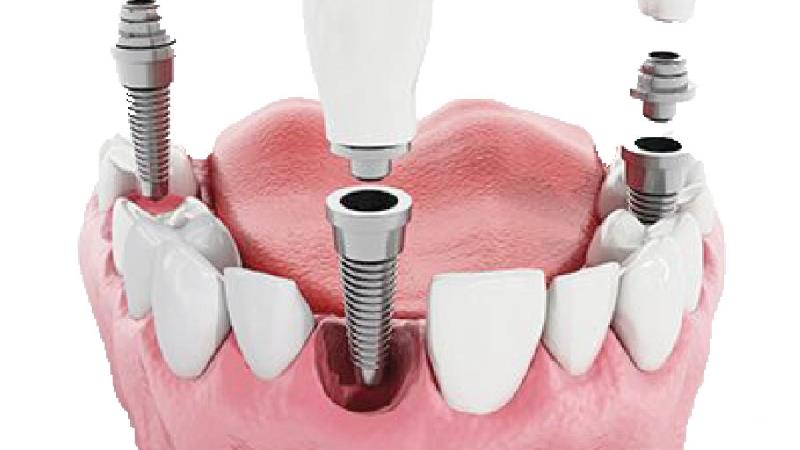 ایمپلنت دندان چه معایت و مزایایی دارد
