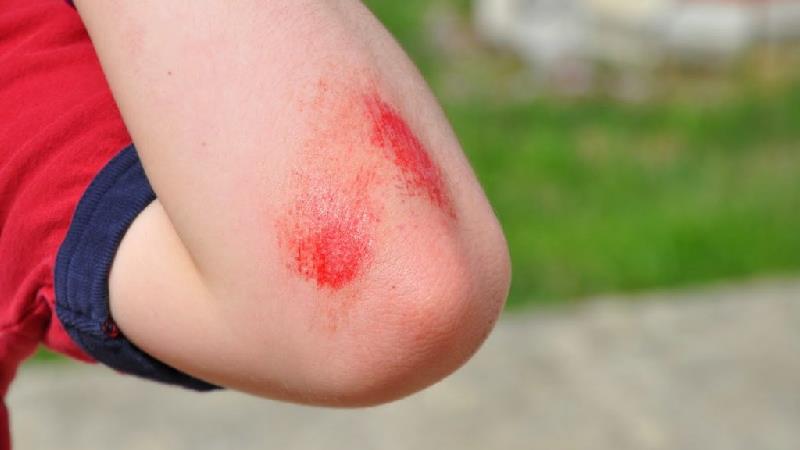 اثر زخم با ویتامین E  از بین نمی رود