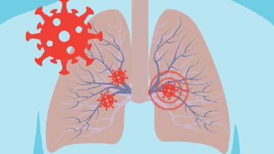 درگیری ریه با کرونا چه نشانه هایی دارد