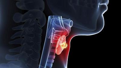 روش درمان تیروئید پرکار با طب سنتی چگونه است